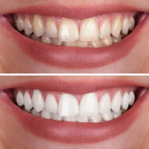 Teeth Whitening Course