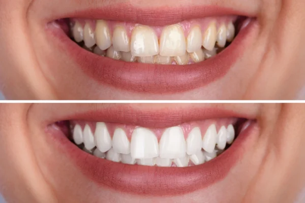 Teeth Whitening Course